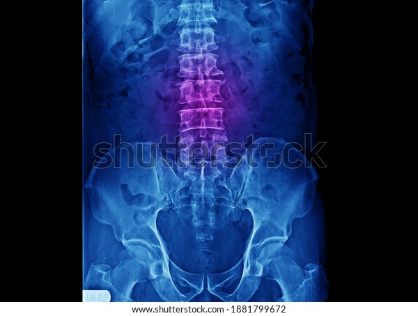 A radiograph\
of lumbar spine and pelvis showing normal bones and joints without\
sign of osteoarthritis, spondylosis or infection. The patient had\
low back pain and hip pain.