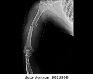 radial groove humerus