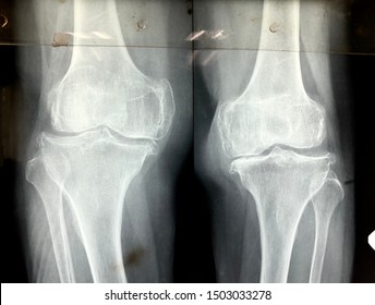 Radiograph Of Severe Bilateral Knee Osteoarthritis With Evidence Of Joint Narrowing , Osteophytes And  Varus Deformity