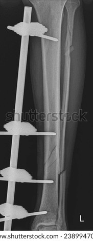 Radiographic Assessment of Tibia and Fibula Fracture External Fixation: Orthopedic Intervention and Lower Limb Stabilization
