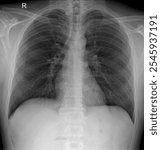 Radiographic Chest X-Ray: Key Diagnostic Tool for Lung and Heart Assessment