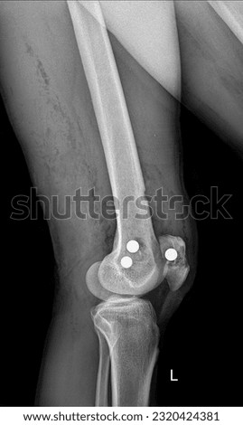  Radiographic image of the knee joint X-ray exhibiting metal artifacts from a gunshot wound