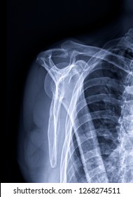 Radiographic Image Xray Image Shoulder Joint Stock Photo 1268274511 ...