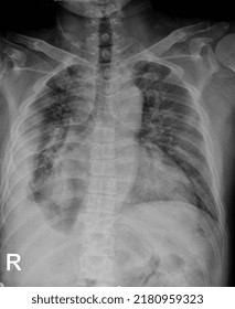 Radiographs Of Lung Abnormalities. Pleural Effusion Is A Condition When There Is Abnormal Fluid In The Pleural Cavity. The Pleura Is A Thin Membrane That Lines The Lungs And Chest Wall.