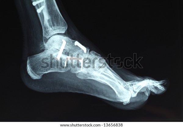 Radiography Foot Stock Photo (Edit Now) 13656838