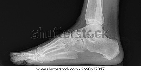 radiography of a foot with a clear example of a case of a heel spur.