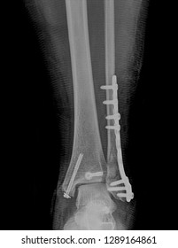 Radiography Fracture Ankle And Foot