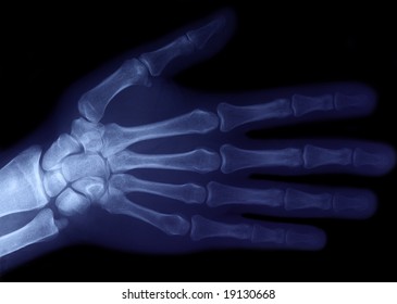 Normal Radiography Hand Wrist Bones Traumatology Stock Photo 1575276835 ...