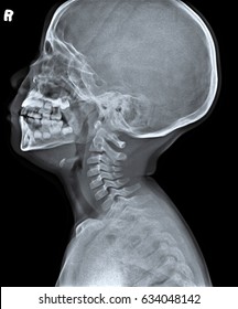 Radiography Of Head Of Human Child Showing Milk Teeth.