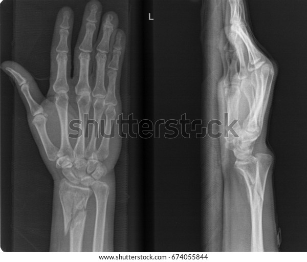 Radiography Hospital Closed Fracture Radius Ulna Stock Photo 674055844 ...