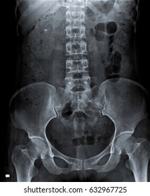 Radiography Of Kidney With Intravenous Contrast At One Hour. 