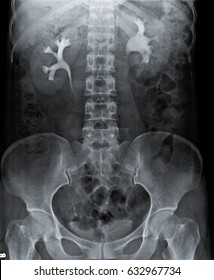 Radiography Of Kidney With Intravenous Contrast At One Hour. 