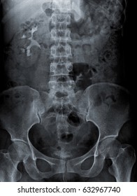 Radiography Of Kidney With Intravenous Contrast At One Hour. 