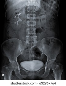 Radiography Of Kidney With Intravenous Contrast At One Hour. 