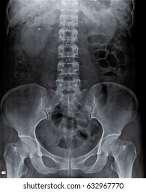 Radiography Of Kidney With Intravenous Contrast At One Hour. 