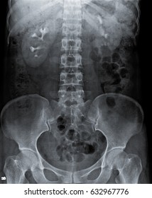 Radiography Of Kidney With Intravenous Contrast At One Hour. 