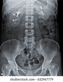 Radiography Of Kidney With Intravenous Contrast At One Hour. 