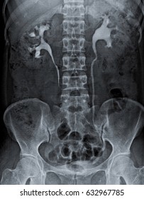 Radiography of kidney with intravenous Contrast at one hour. 