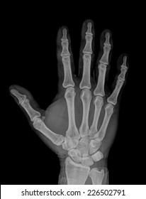 A radiography of the right hand - Shutterstock ID 226502791