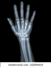 radiography of right hand with all fingers. - Shutterstock ID 632094419
