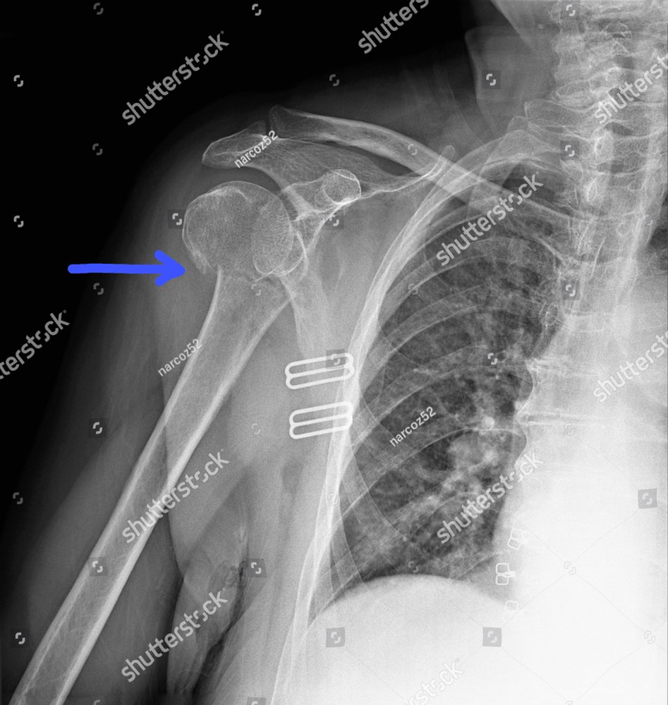 radiography of the shoulder joint in direct projection with a fracture ...