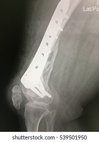 The Radiography Show Fracture Of Right Femur With Old Fish Plate