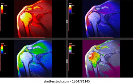 Radiology Imaging of Human Musculoskeletal System- Shoulder MRI (Magnetic Resonance Image) High Resolution