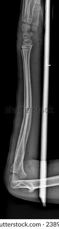 Radius and Ulna Fracture X-ray - Forearm Trauma Assessment.