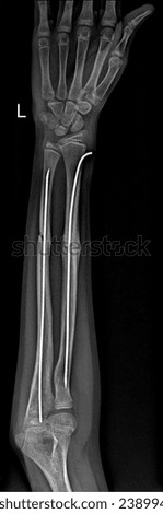 Radius and ulna Shaft Fracture Intramedullary Nail Fixation X-ray:
Detailed X-ray illustrating successful fixation of a radius and ulna shaft fracture using an intramedullary nail. 