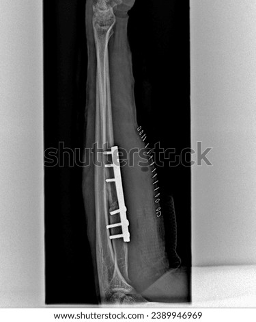 Radius and Ulna Shaft Fracture X-ray - Forearm Trauma Evaluation.