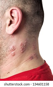 Raised Red Bumps And Blisters Caused By The Shingles Virus