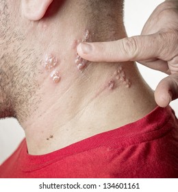 Raised Red Bumps And Blisters Caused By The Shingles Virus