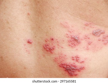 Raised Red Bumps And Blisters Caused By Shingles On Skin