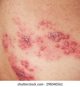 Raised Red Bumps And Blisters Caused By Shingles On Skin