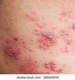 Raised Red Bumps And Blisters Caused By Shingles On Skin