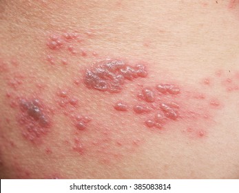 Raised Red Bumps And Blisters Caused By Shingles On Skin