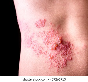 Raised Red Bumps And Blisters Caused By Shingles On Skin