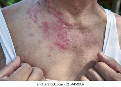 Raised red bumps, skin rash and blisters on body caused by infection of Herpes zoster virus. Shingles, chickenpox rash, zoster virus, urticaria rash. atopic dermatitis.