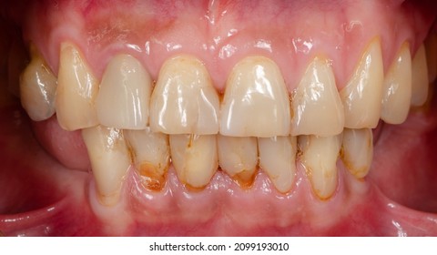 5 Rampant caries Images, Stock Photos & Vectors | Shutterstock