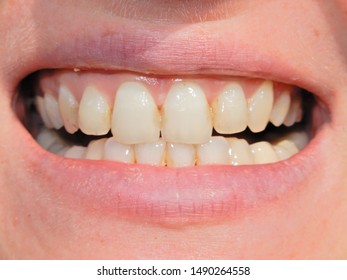 a range of white teeths in an open mouth of a young man or woman - Shutterstock ID 1490264558