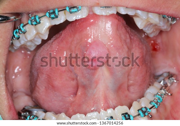 Ranula Cyst Ventral Tongue Stock Photo 1367014256 | Shutterstock