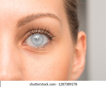 Rapresentation Of Eye With Corneal Opacity