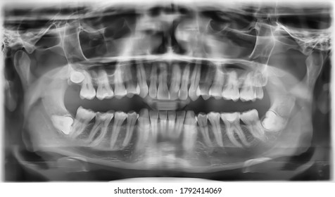 Rare Full Dental X Ray with fully Impacted Wisdom Tooth / Teeth