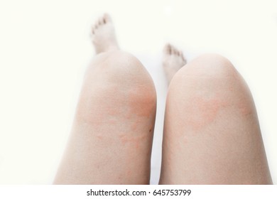 Rash from allergic infection, eczema dermatitis