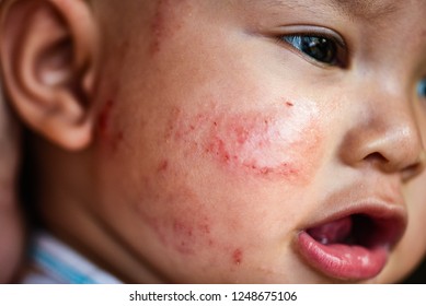 rash baby allergy on face, eczema atopic baby dermatitis child disease baby girl face dry skin itching and lesion caused from allergy in newborn asia