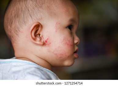 Rash Baby Allergy On Face / Disease Baby Girl Face Dry Skin Itching And Lesion Caused From Allergy In Newborn Asia 