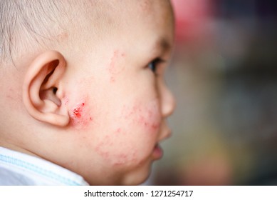 Rash Baby Allergy On Face / Disease Baby Girl Face Dry Skin Itching And Lesion Caused From Allergy In Newborn Asia 