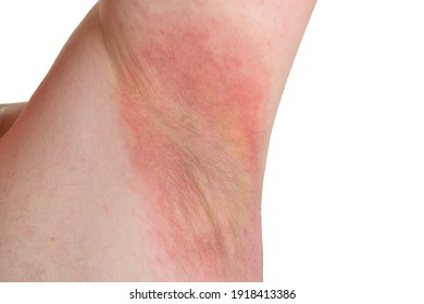 Armpit Rash: 14 Possible Causes and How to Treat Them