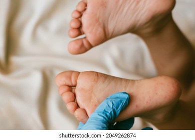 Rash of enterovirus infection picornavirus families on the feet of a 3-year-old child. Medicine, health concept - Shutterstock ID 2049262874