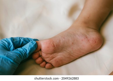Rash of enterovirus infection picornavirus families on the feet of a 3-year-old child. Medicine, health concept - Shutterstock ID 2049262883